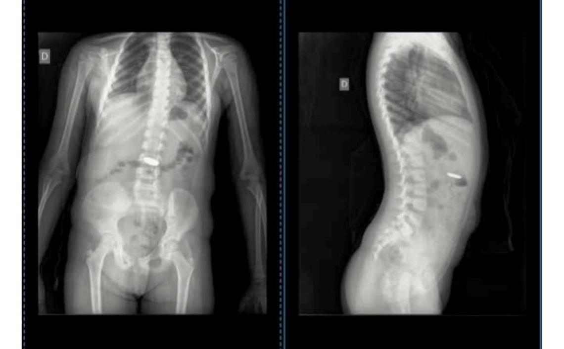 Una madre de Chascomús comunicó en redes sociales que debió consultar a 7 médicos para constatar que su hija se había tragado una pila