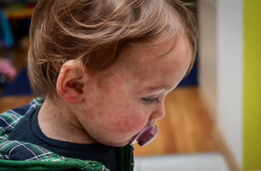 Sarampión: alerta epidemiológico en la región por un aumento exponencial de casos