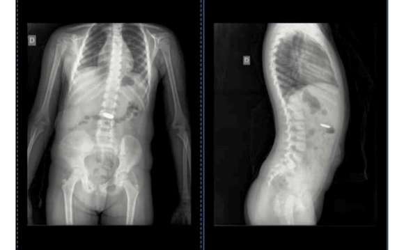 Una madre de Chascomús comunicó en redes sociales que debió consultar a 7 médicos para constatar que su hija se había tragado una pila