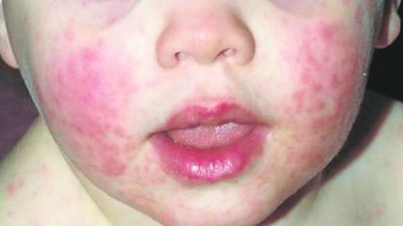 Aumento de casos de Quinta Enfermedad en EE. UU.: Lo que debes saber