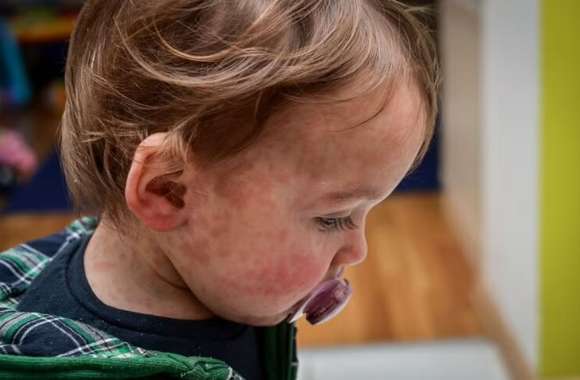 Sarampión: alerta epidemiológico en la región por un aumento exponencial de casos